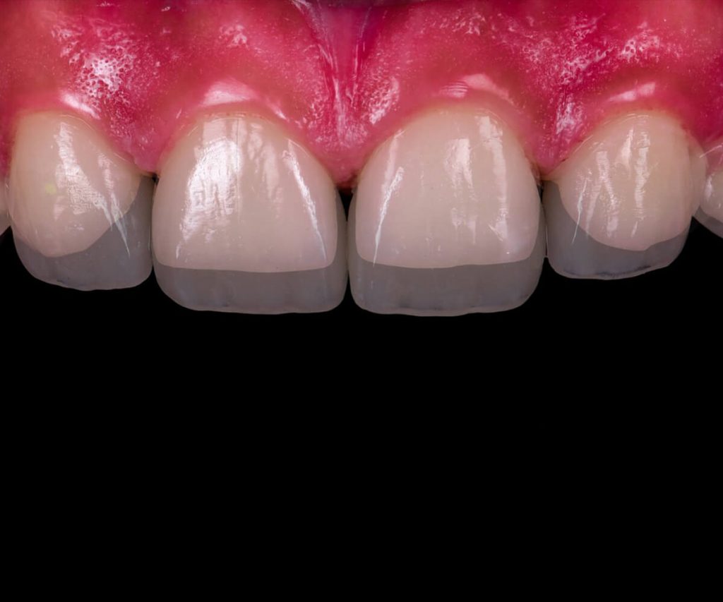 Fatete dentare Craiova - clinica_zambetul_fatete-dentare